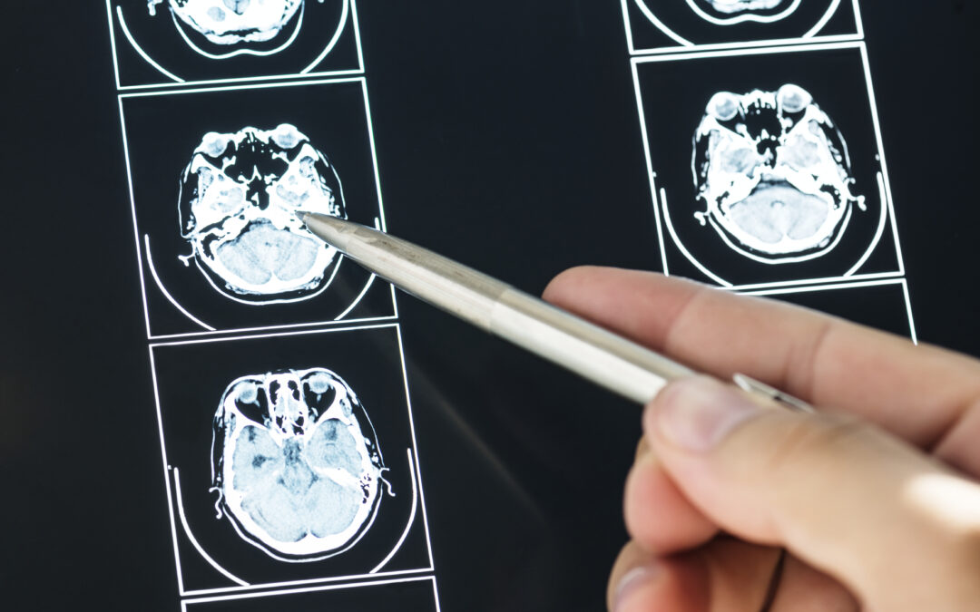 Traumatic Brain Injuries After a Car Accident: Symptoms, Diagnosis, and Treatment