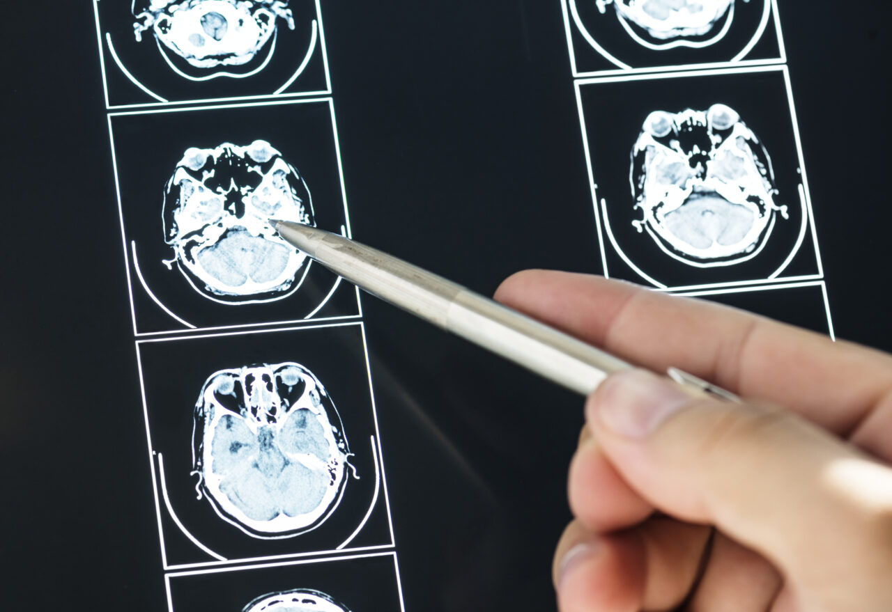 Traumatic Brain Injuries After a Car Accident: Symptoms, Diagnosis, and ...